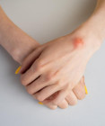 Lipóm – keď si "tuková hrčka" vyžaduje pozornosť lekára